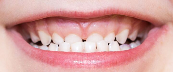 Malocclusion Dentaire : Comprendre et Agir