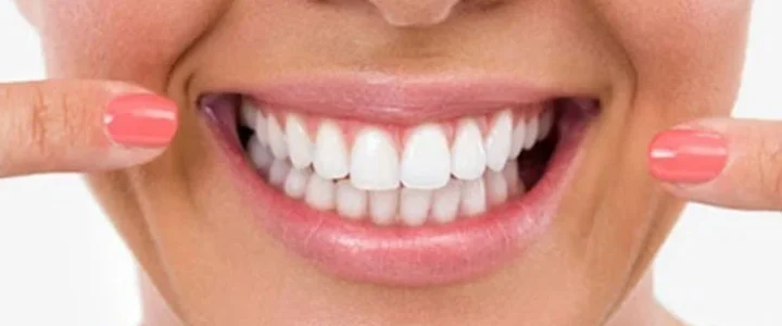 Quand refaire un traitement de blanchiment dentaire ?